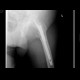 Pertrochanteric fracture of femur, osteosynthesis, refracture, total endoprosthesis: X-ray - Plain radiograph